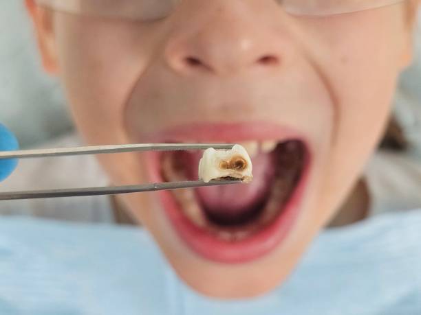 Best Emergency Dental Extractions in North Lewisburg, OH